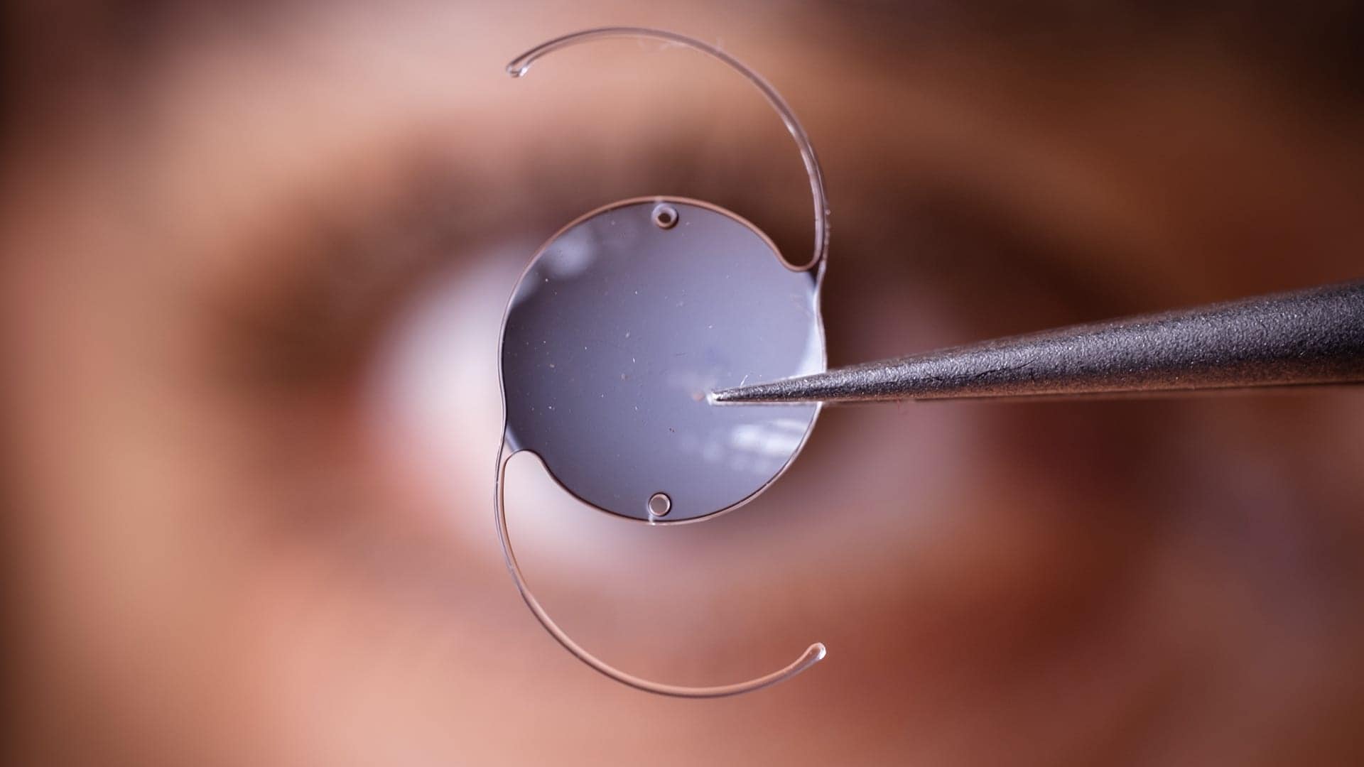 implants autres techniques centre union laser vision chirurgie refractive toulouse