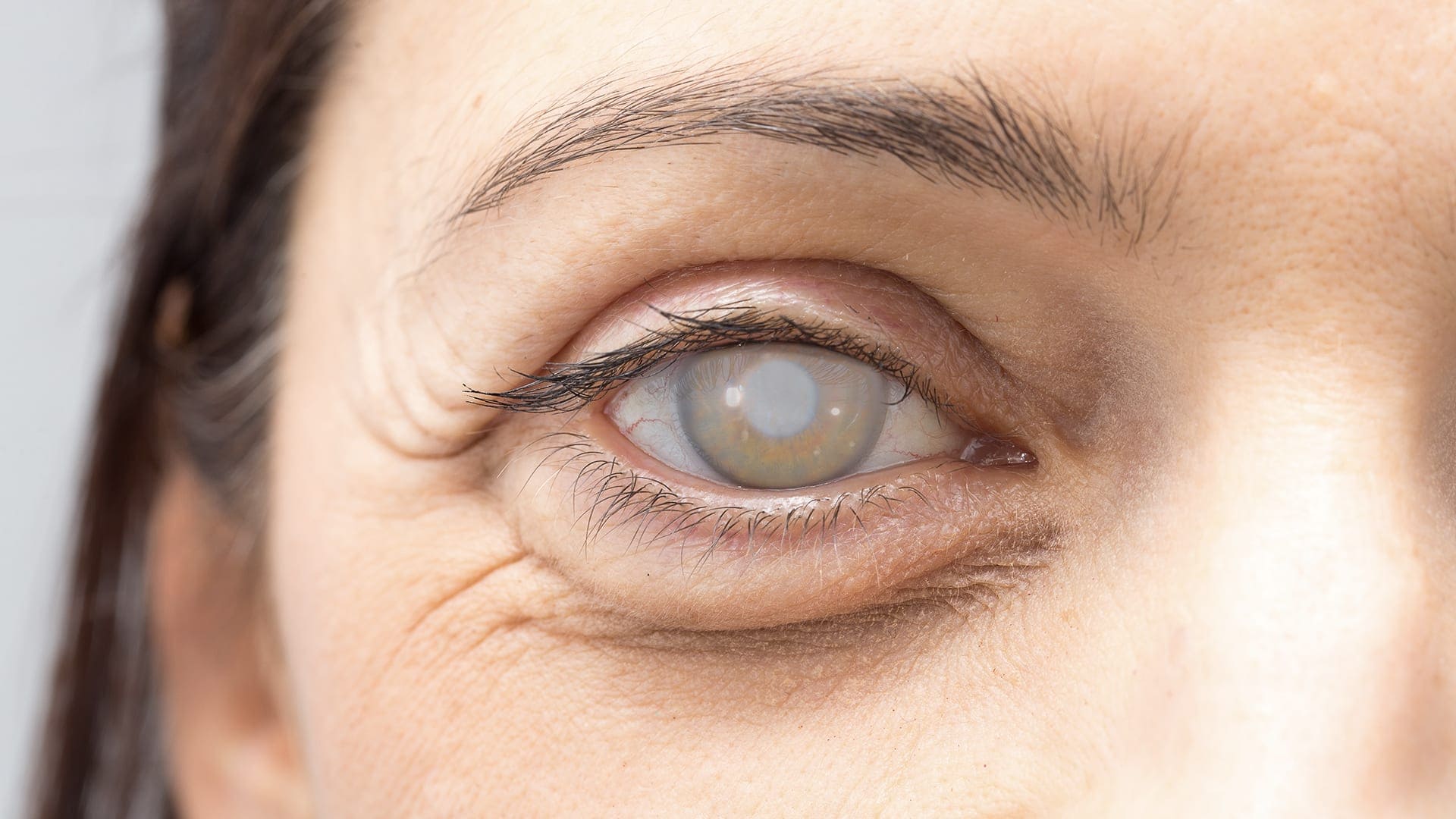 cataracte operation centre union laser vision chirurgie refractive toulouse