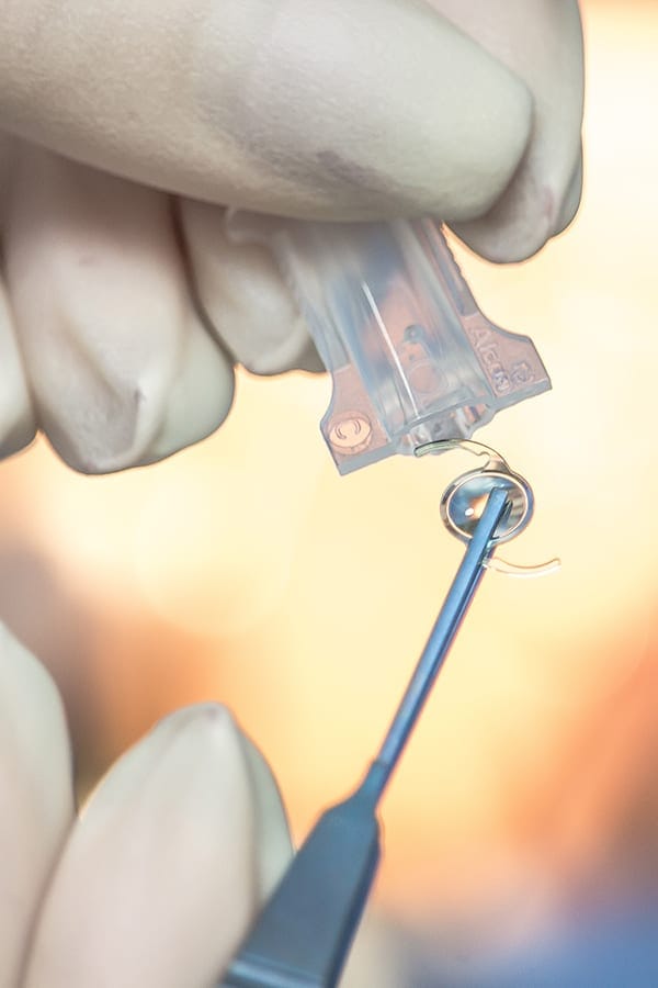 implants intra oculaires centre union laser vision chirurgie refractive toulouse specialistes ophtalmologie implants intra oculaires centre union laser vision chirurgie refractive toulouse specialistes ophtalmologie