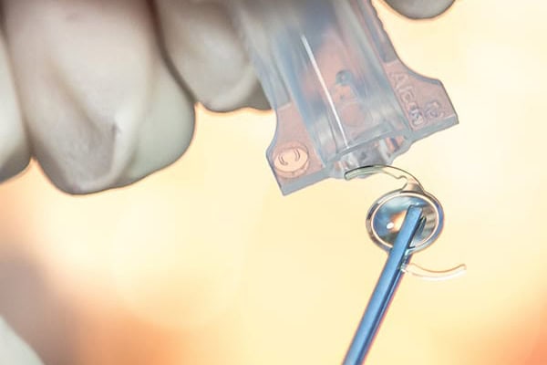 implants intra oculaires centre union laser vision toulouse chirurgie refractive toulouse specialistes ophtalmologie