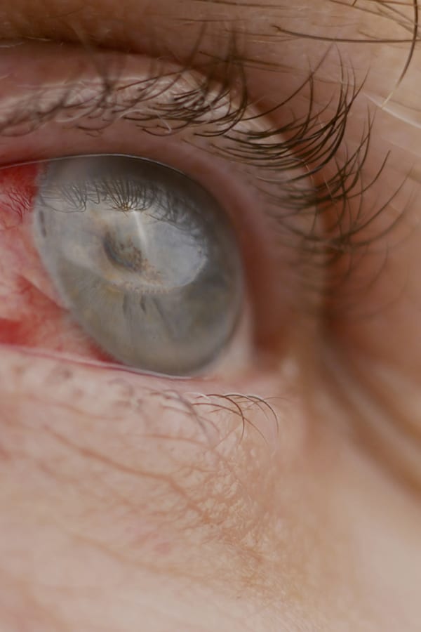 qu est ce que la cataracte centre union laser vision chirurgie refractive toulouse specialistes ophtalmologie