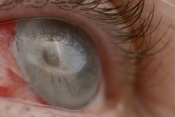 qu est ce que la cataracte centre union laser vision toulouse chirurgie refractive toulouse specialistes ophtalmologie